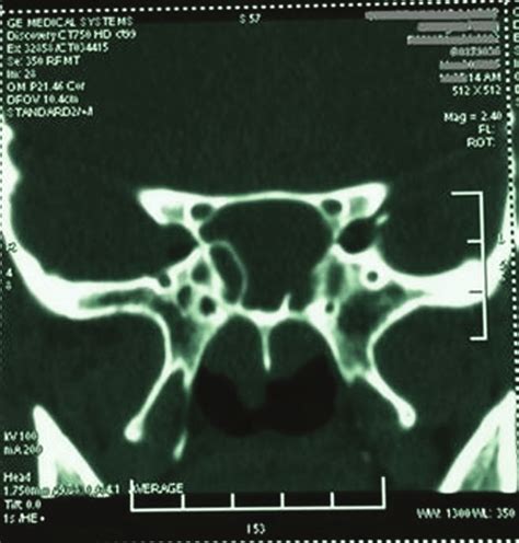 Computed tomography (CT) scan and location of the vidian canal. A... | Download Scientific Diagram