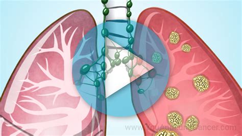 Animation - Staging of Lung Cancer