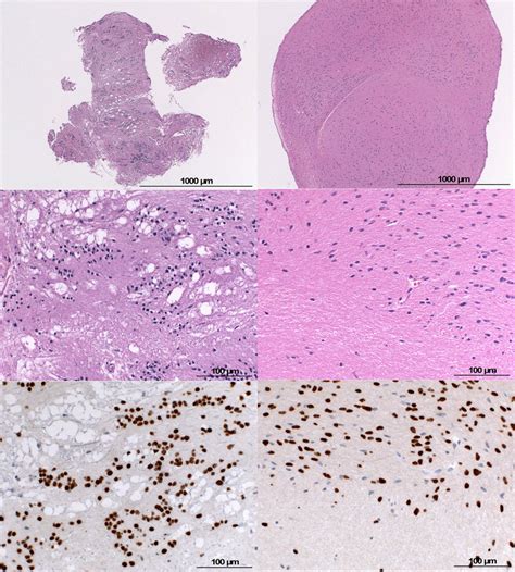 Diffuse midline glioma with initial histological diagnosis of ...