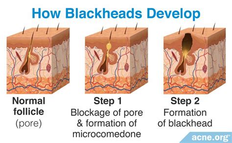 What Is a Blackhead? - Acne.org