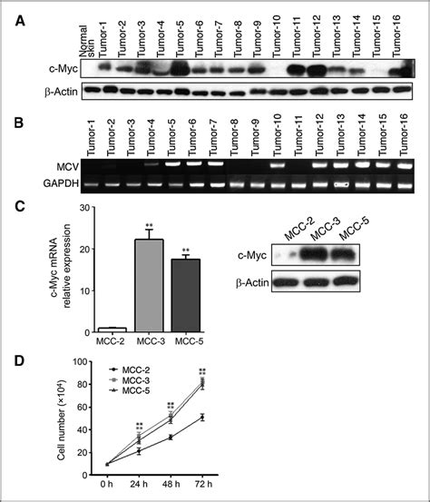 c-Myc protein expression in MCC fresh tumors and primary cell lines. A ...