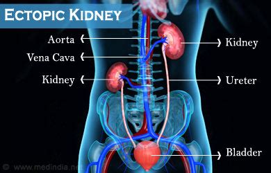 Ectopic Kidney | Renal Ectopia - Causes, Symptoms, Diagnosis, Treatment, Complications