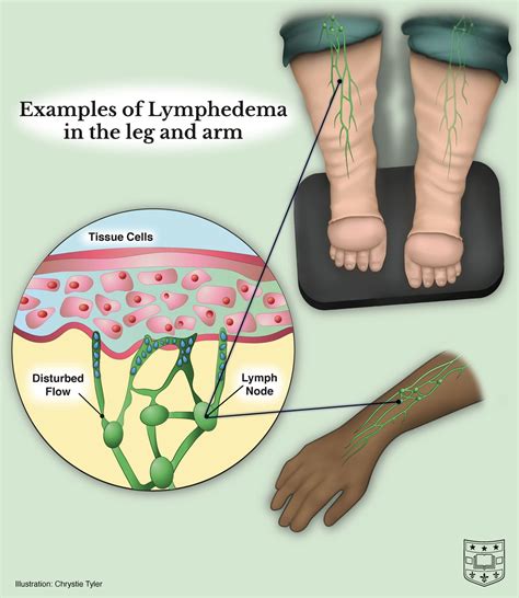 Ask the Doctors: Lymphedema Symptoms and Causes with Doctors Sacks and Anolik | Department of ...