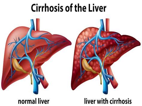 Cirrhosis: Symptoms, Causes, Diagnosis, and Treatment