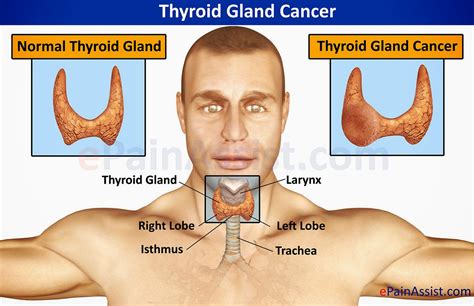 Wellness Lab Health Info: How To Spot Thyroid Cancer