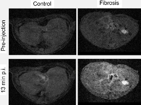 Detecting chronic liver disease with targeted MRI • healthcare-in ...