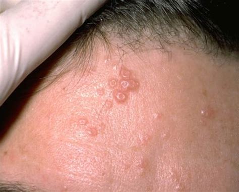 Molluscum Contagiosum Causes, Transmission, Treatment & Prevention