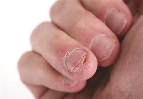 Nail Biting May Be a Hard Habit to Break but These Tips Can Help You ...