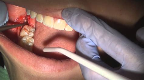 Impacted wisdom teeth | Argentina| PDF | PPT| Case Reports | Symptoms | Treatment