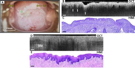 Typical images of HSIL cervical tissues. Colposcopy image (A), OCT ...