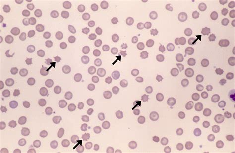 Acanthocytes – Cells and Smears