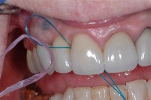 What is the difference between Superfloss, floss threaders, floss picks and dental floss? | News ...