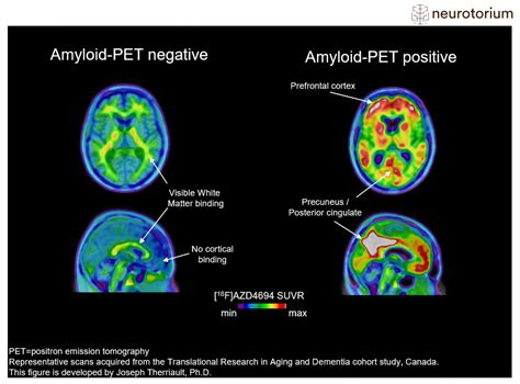 Amyloid-PET imaging in Alzheimer's disease - Neurotorium