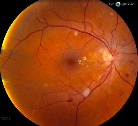 Hypertensive retinopathy