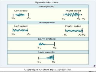 Systolic murmurs | PPT