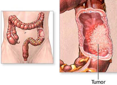 Bowel Cancer Treatment | Modern Cancer Hospital Guangzhou, China