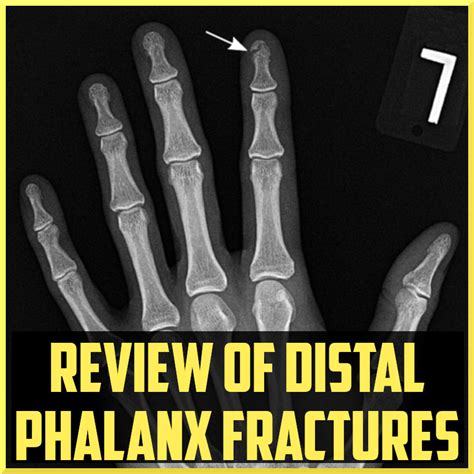 Review of Distal Phalanx Fractures - Sports Medicine Review