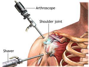 Shoulder Arthroscopy & Subacromial Decompression - Dr Shannon Sim