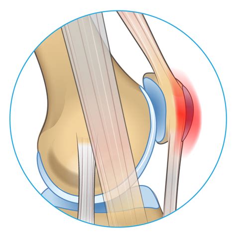 Knee Pain on the Front of Your Joint? Learn Why. - Spring Loaded Technology