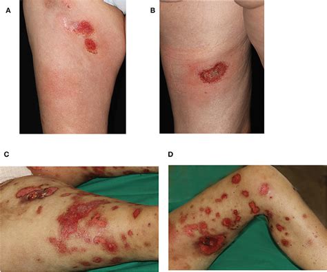 Frontiers | Primary Cutaneous Gamma-Delta T-Cell Lymphoma With Long-Term Indolent Clinical ...