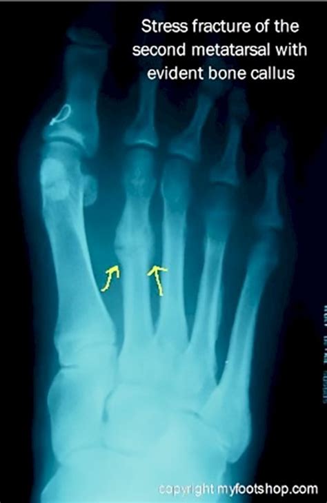 Metatarsal Fractures | Causes and treatment options | MyFootShop.com