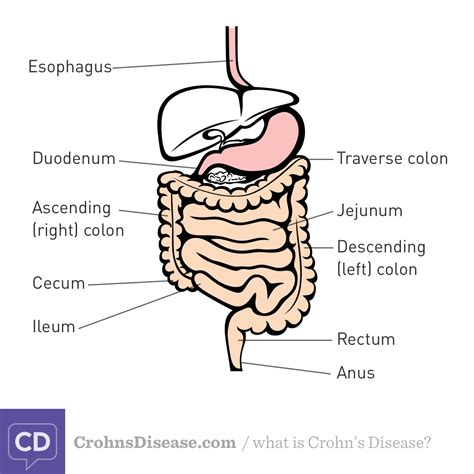 What Are the Different Types of Crohn's Disease? | IBD