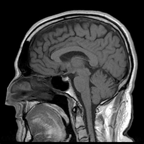 Diffusion MRI technology demonstrates neurological abnormalities months ...