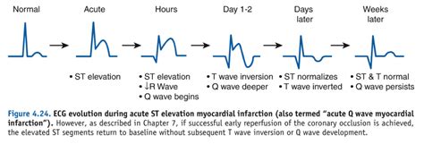 Acute STEMI Management - Mnemonic based approach | Epomedicine