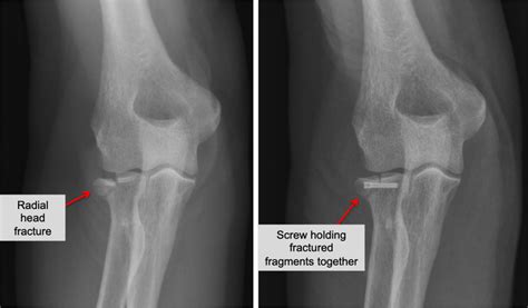 Elbow radial head fracture | doctorvisit