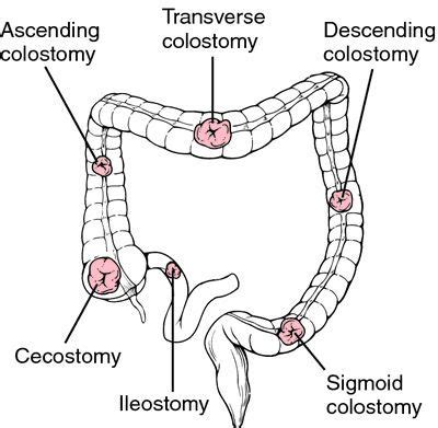 What's A Stoma - STPM Informasion