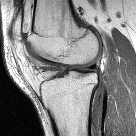 Synovial Plicae of the Knee | Radsource