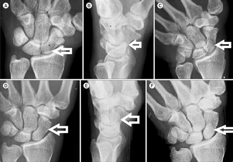 Ulnar Deviation X Ray