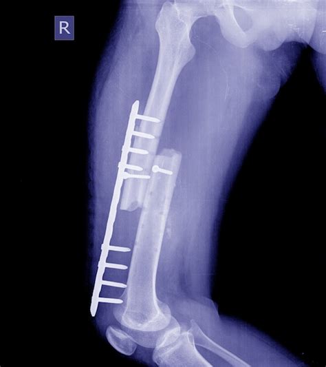 Premium Photo | Broken leg x-rays image,x-ray image of fracture leg ...