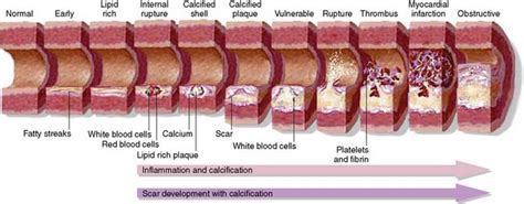 Coronary Artery Calcification: Pathogenesis, Imaging, and Risk ...