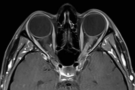 Optic neuritis. - Neuro MR Case Studies - CTisus CT Scanning