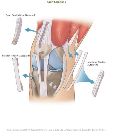 Best Way To Reconstruct ACL | Children's Hospital Colorado