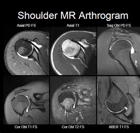 Shoulder MRI