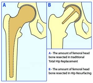 Golfer Norman Gidney bilateral Birmingham Hip Resurfacing BHR | Hip ...