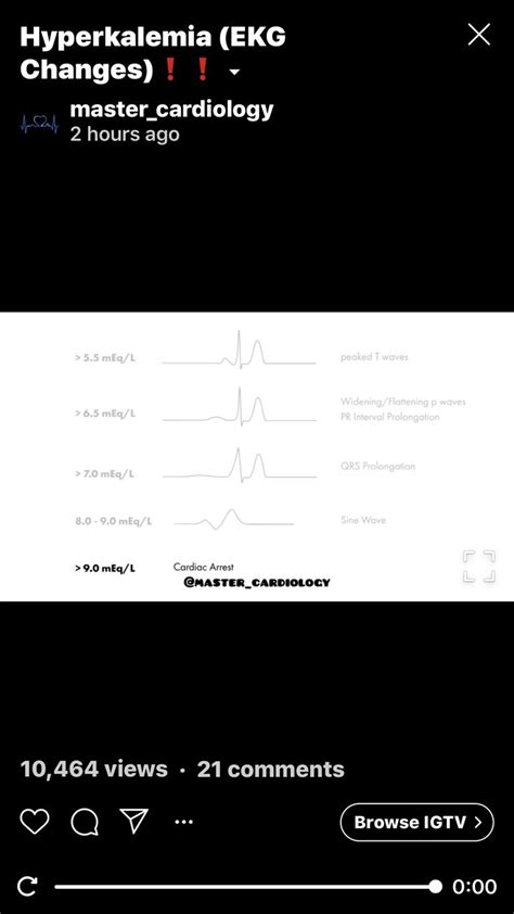 Pr Interval, Icu Rn, Hyperkalemia, Cardiac Arrest, Sine Wave, Ekg ...