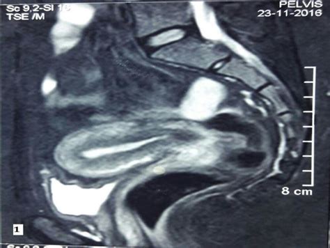 Preoperative MRI showing mild arcuate uterus with min fluid in vaginal ...