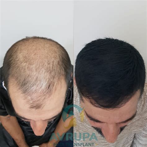 FUE Hair Transplant Results : 10 Real Cases With Photos - Clinic Advisor