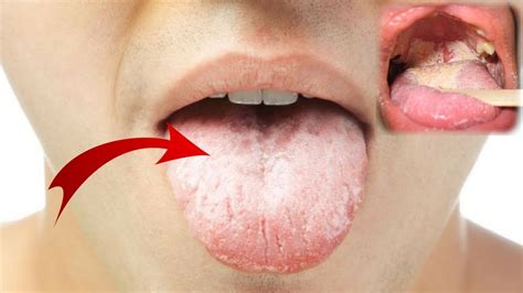 Oral Thrush Under Tongue