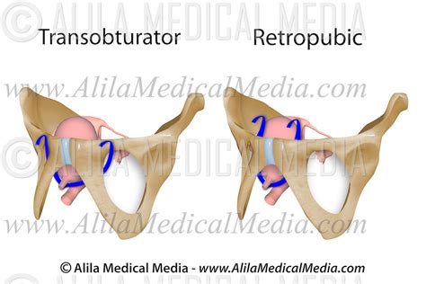 Mid-Urethral Sling - Transobturator versus Retropubic | Alila Medical Images