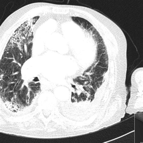 (PDF) Human infection by Pasteurella canis – A case report