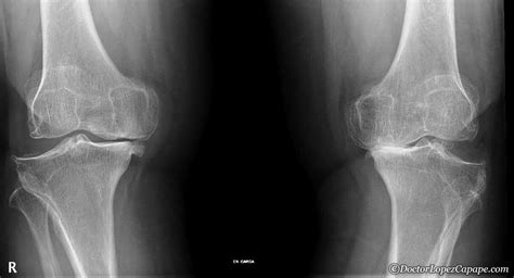 Salida Mago Pez anémona pinzamiento femorotibial interno rodilla Consejo Fascinante explosión