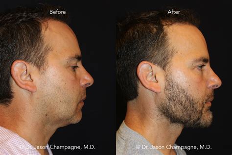 Custom Chin and Jaw Implants — Plastic Surgeon Beverly Hills, CA | Dr ...