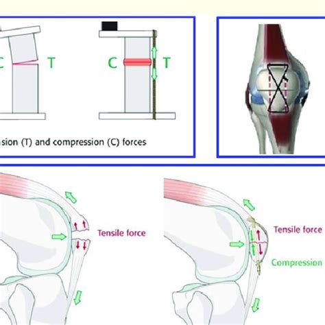 Principle of patellar tension band wiring. Biomechanical factors ...