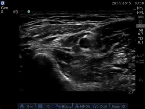 Ultrasound guided superficial radial nerve block in the forearm. - YouTube