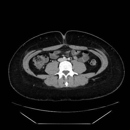 Normal CT abdomen and pelvis - female | Image | Radiopaedia.org