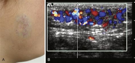 Vascular Anomalies | Radiology Key